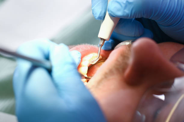 Best Knocked-Out Tooth (Avulsed Tooth) Treatment in Peralta, NM