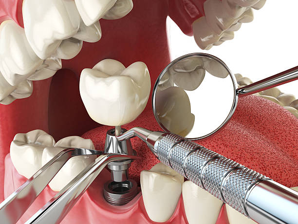 Best Emergency Denture Repair in Peralta, NM